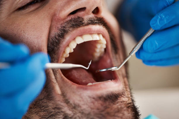 Best Knocked-Out Tooth (Avulsed Tooth) Treatment in Shawnee, KS
